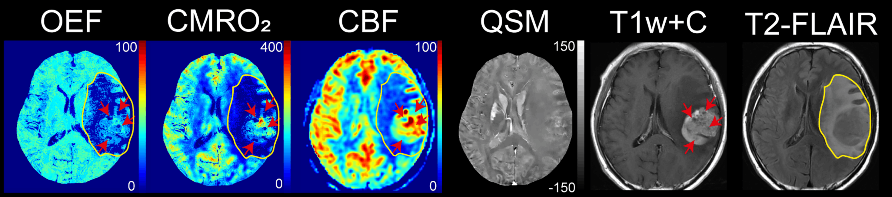 Brain imaging techniques including OEF, CMRO2, CBF, QSM, T1w+C, and T2-FLAIR