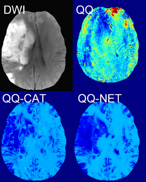 Data processing techniques showing DWI, QQ, QQ-CAT, and QQ-NET brain imaging results